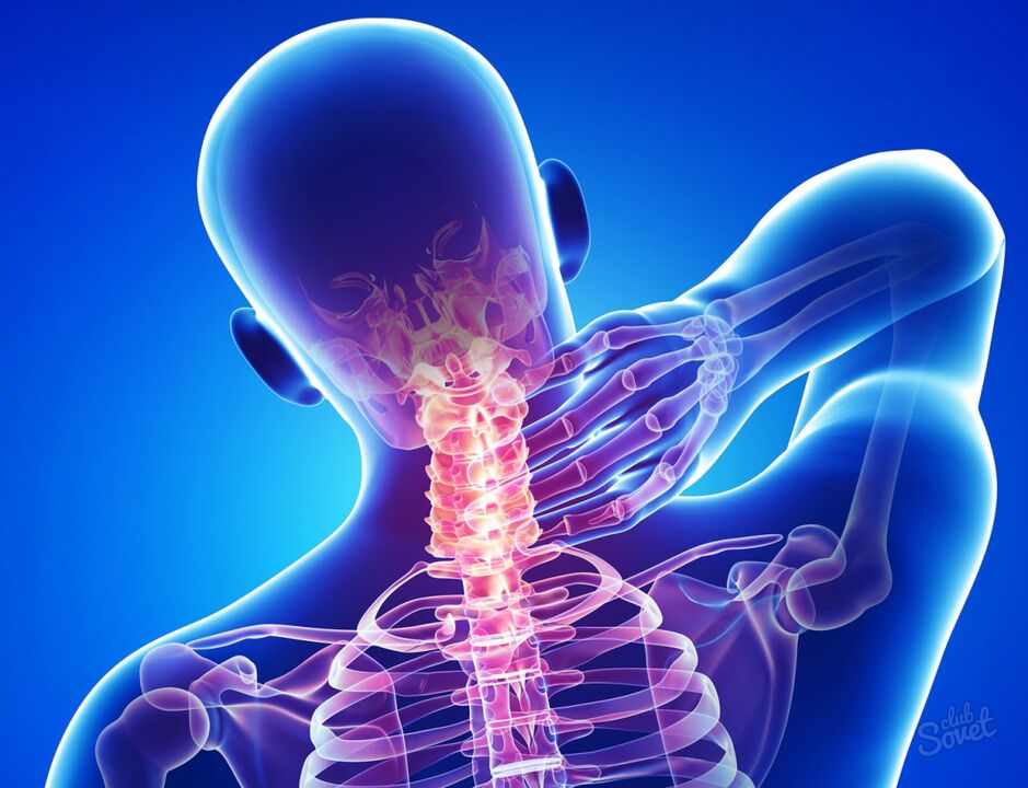 servikal osteokondroz