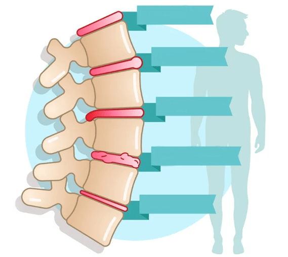 Torasik osteokondroz hastalığı derecesi