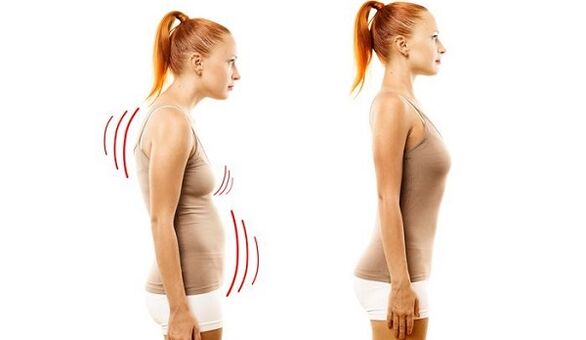 Servikal osteokondrozlu düz sırt ve kötü duruş