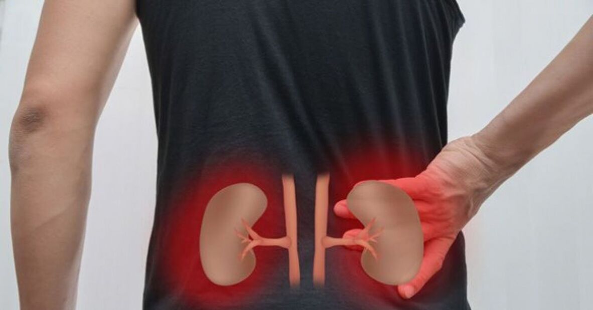 Bel ağrısının bir nedeni olarak böbrek hastalığı